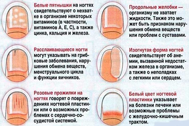 Ногти на руках стали ребристые причина Ногти на руках стали ребристые причина