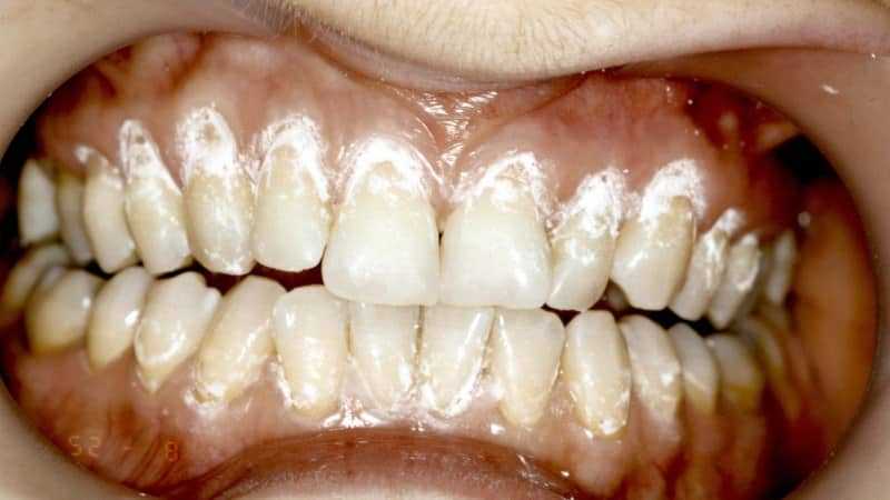 чувствительные зубы болят