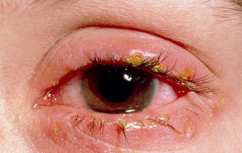 воспаление глаза как вылечить в домашних условиях