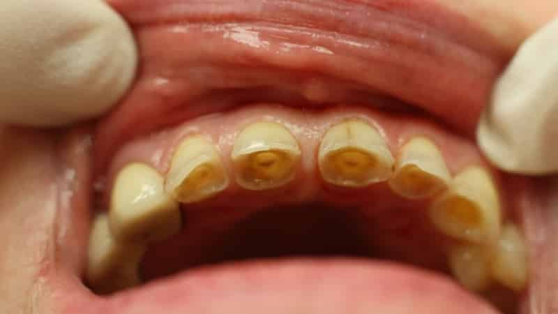 чувствительные зубы болят